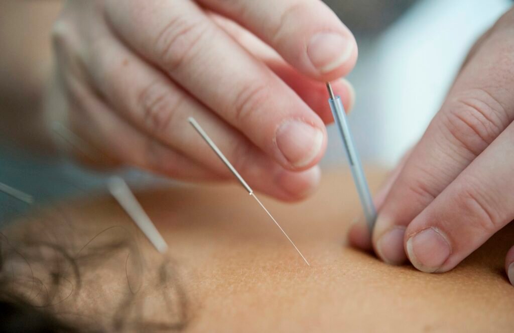 Acupuncture needles during a treatment at an acupuncture clinic