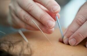 Acupuncture needles placed during a treatment